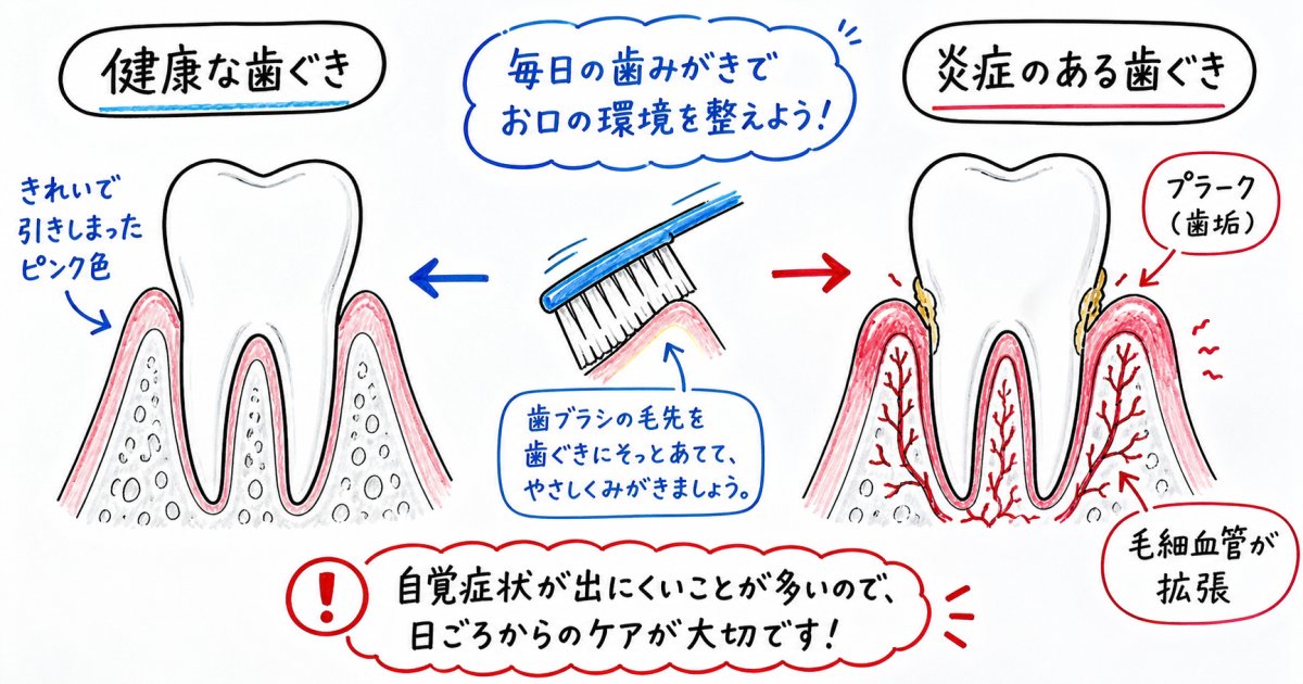 歯磨きのたびに出血する主な原因と「痛くないから大丈夫」という誤解